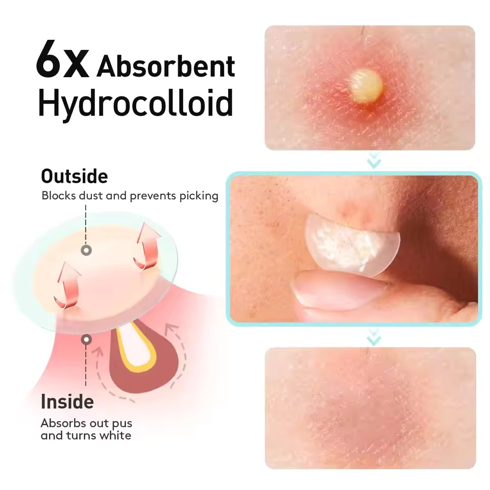 แผ่นแปะสิว 360 ชิ้น/กล่อง - ปร - Face Oil บทวิจารณ์และราคา