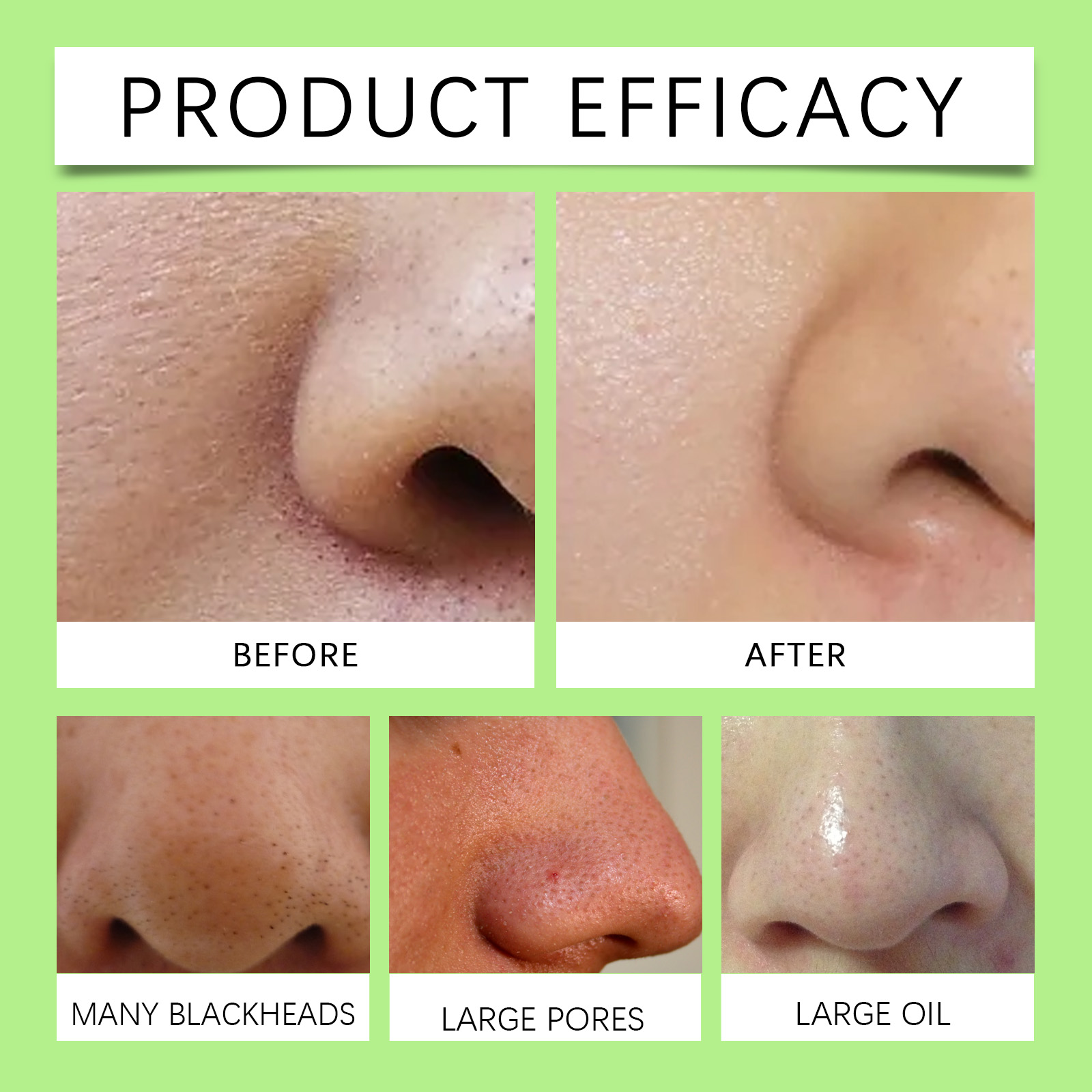 แผ่นแปะจมูกถ่านไม้ไผ่สำหรับสิว - Skincare China บทวิจารณ์และราคา
